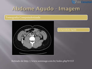 Tomografia Computadorizada
(1)Apendicite Aguda
Retirado de http://www.sonimage.com.br/index.php?t=113
 