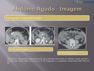 Tomografia Computadorizada
(1) Pancreatite Aguda
(2) Níveis Hidroaéreos
Retirado de: Tomografia computadorizada sem contraste intravenoso no abdome agudo: quando e
por que usar. Freire, Filho, E. O., Jesus, P. E. M., D’Ippolito, G., Szejnfeld, J. Radiol Bras 2006; 39(1): 51-
62
 