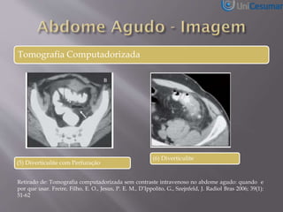 Tomografia Computadorizada
(5) Diverticulite com Perfuração
(6) Diverticulite
Retirado de: Tomografia computadorizada sem contraste intravenoso no abdome agudo: quando e
por que usar. Freire, Filho, E. O., Jesus, P. E. M., D’Ippolito, G., Szejnfeld, J. Radiol Bras 2006; 39(1):
51-62
 