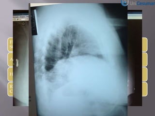 FEMINO, 67 ANOS, QUEIXA PRINCIPAL FRAQUEZA E
SONOLENCIA. ALIMENTA-SE BEM E AFEBRIL.
ABDOME FLACIDO E INDOLOR, RHA + E NL
HMG NORMAL
RX TORAX ELEVAÇÃO CUPULA DIAFRAGMATICA DIREITA
COM CONDENSAÇÃO PULMONAR OU PNEUMOPERITONEO?
 