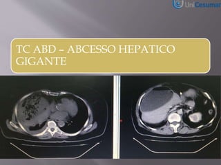 TC ABD – ABCESSO HEPATICO
GIGANTE
 