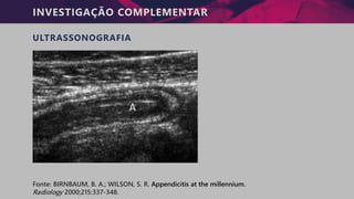 INVESTIGAÇÃO COMPLEMENTAR
ULTRASSONOGRAFIA
Fonte: BIRNBAUM, B. A.; WILSON, S. R. Appendicitis at the millennium.
Radiology 2000;215:337-348.
 