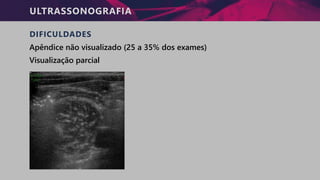 ULTRASSONOGRAFIA
DIFICULDADES
Apêndice não visualizado (25 a 35% dos exames)
Visualização parcial
 