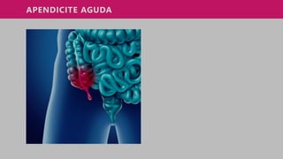 APENDICITE AGUDA
 