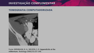 INVESTIGAÇÃO COMPLEMENTAR
TOMOGRAFIA COMPUTADORIZADA
Fonte: BIRNBAUM, B. A.; WILSON, S. R. Appendicitis at the
millennium. Radiology 2000;215:337-348.
 