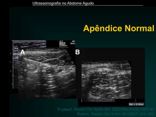 Ultrassonografia no Abdome Agudo
Rybkin. Radiol Clin N Am 45 (2007) 411–422
Apêndice Normal
Puylaert. Radiol Clin North Am. 2003 Nov;41(6):1227-42
 