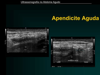 Ultrassonografia no Abdome Agudo
Apendicite Aguda
 