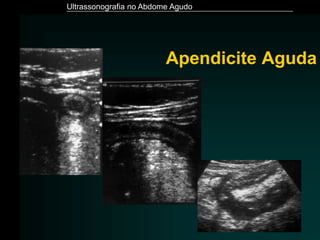 Ultrassonografia no Abdome Agudo
Apendicite Aguda
 