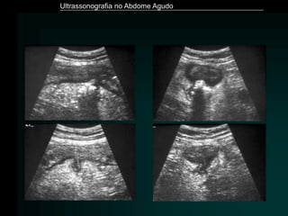 Ultrassonografia no Abdome Agudo
 