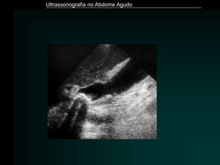 Ultrassonografia no Abdome Agudo
 