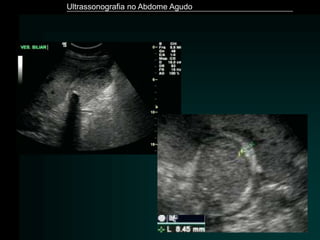 Ultrassonografia no Abdome Agudo
 
