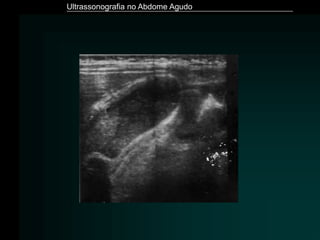 Ultrassonografia no Abdome Agudo
 