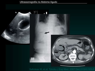 Ultrassonografia no Abdome Agudo
Safioleas M, et al. Tohoku J Exp Med. 2007 Dec;213(4):323-8
 