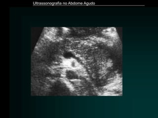 Ultrassonografia no Abdome Agudo
 