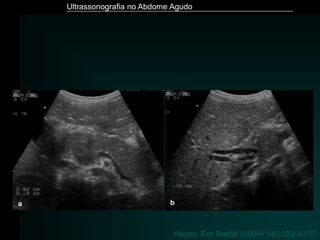 Ultrassonografia no Abdome Agudo
Hayes. Eur Radiol (2004) 14:L123–L137
 