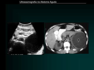 Ultrassonografia no Abdome Agudo
 
