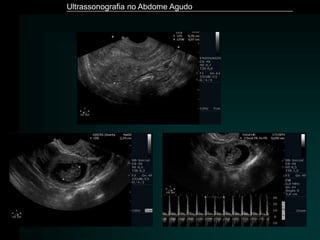 Ultrassonografia no Abdome Agudo
 