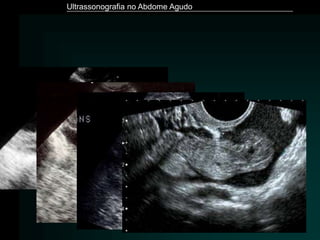 Ultrassonografia no Abdome Agudo
 