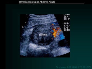 Ultrassonografia no Abdome Agudo
Birnbaum. AJR 1998;1 70:361-371
 
