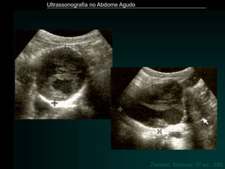 Ultrassonografia no Abdome Agudo
Zwiebel, Elsevier, 5ª ed.: 286
 
