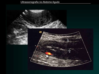 Ultrassonografia no Abdome Agudo
 