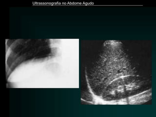 Ultrassonografia no Abdome Agudo
 