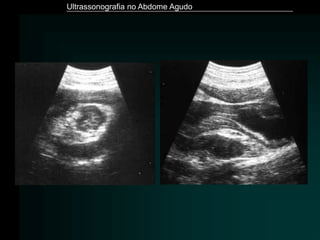 Ultrassonografia no Abdome Agudo
 
