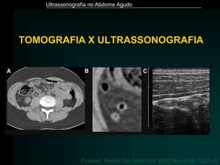 Ultrassonografia no Abdome Agudo
TOMOGRAFIA X ULTRASSONOGRAFIA
Puylaert. Radiol Clin North Am. 2003 Nov;41(6):1227-42
 