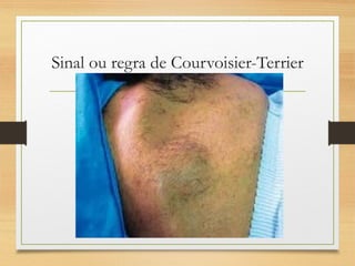 Sinal ou regra de Courvoisier-Terrier
 