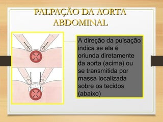 PALPAÇÃO DA AORTAPALPAÇÃO DA AORTA
ABDOMINALABDOMINAL
A direção da pulsação
indica se ela é
oriunda diretamente
da aorta (acima) ou
se transmitida por
massa localizada
sobre os tecidos
(abaixo)
 