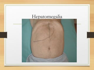 Hepatomegalia
 