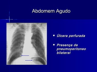  Úlcera perfuradaÚlcera perfurada
 Presença dePresença de
pneumoperitoneopneumoperitoneo
bilateralbilateral
Abdomem AgudoAbdomem Agudo
 