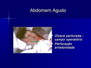  Úlcera perfurada -Úlcera perfurada -
campo operatóriocampo operatório
 PerfuraçãoPerfuração
arredondadaarredondada
Abdomem AgudoAbdomem Agudo
 
