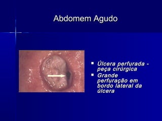  Úlcera perfurada -Úlcera perfurada -
peça cirúrgicapeça cirúrgica
 GrandeGrande
perfuração emperfuração em
bordo lateral dabordo lateral da
úlceraúlcera
Abdomem AgudoAbdomem Agudo
 