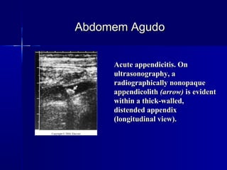      
Acute appendicitis. OnAcute appendicitis. On
ultrasonography, aultrasonography, a
radiographically nonopaqueradiographically nonopaque
appendicolithappendicolith (arrow)(arrow) is evidentis evident
within a thick-walled,within a thick-walled,
distended appendixdistended appendix
(longitudinal view).(longitudinal view).
Abdomem AgudoAbdomem Agudo
 