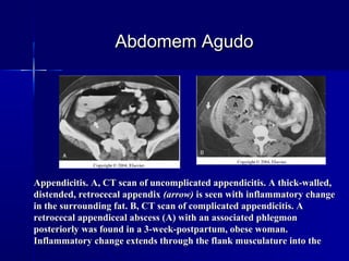 Appendicitis. A, CT scan of uncomplicated appendicitis. A thick-walled,Appendicitis. A, CT scan of uncomplicated appendicitis. A thick-walled,
distended, retrocecal appendixdistended, retrocecal appendix (arrow)(arrow) is seen with inflammatory changeis seen with inflammatory change
in the surrounding fat. B, CT scan of complicated appendicitis. Ain the surrounding fat. B, CT scan of complicated appendicitis. A
retrocecal appendiceal abscess (A) with an associated phlegmonretrocecal appendiceal abscess (A) with an associated phlegmon
posteriorly was found in a 3-week-postpartum, obese woman.posteriorly was found in a 3-week-postpartum, obese woman.
Inflammatory change extends through the flank musculature into theInflammatory change extends through the flank musculature into the
Abdomem AgudoAbdomem Agudo
 