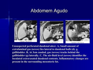 Unsuspected perforated duodenal ulcer. A, Small amount ofUnsuspected perforated duodenal ulcer. A, Small amount of
extraluminal gasextraluminal gas (arrow)(arrow) lies lateral to duodenal bulb (d). g,lies lateral to duodenal bulb (d). g,
gallbladder. B, At 3cm caudad, gasgallbladder. B, At 3cm caudad, gas (arrow)(arrow) tracks behind thetracks behind the
gallbladder (g) laterally. C, The air-fluid levelgallbladder (g) laterally. C, The air-fluid level (arrow)(arrow) identifies theidentifies the
loculated extravasated duodenal contents. Inflammatory changes areloculated extravasated duodenal contents. Inflammatory changes are
present in the surrounding mesenteric fat.present in the surrounding mesenteric fat.
Abdomem AgudoAbdomem Agudo
 