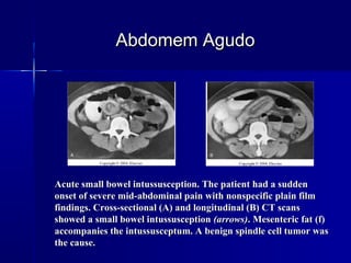 Acute small bowel intussusception. The patient had a suddenAcute small bowel intussusception. The patient had a sudden
onset of severe mid-abdominal pain with nonspecific plain filmonset of severe mid-abdominal pain with nonspecific plain film
findings. Cross-sectional (A) and longitudinal (B) CT scansfindings. Cross-sectional (A) and longitudinal (B) CT scans
showed a small bowel intussusceptionshowed a small bowel intussusception (arrows)(arrows). Mesenteric fat (f). Mesenteric fat (f)
accompanies the intussusceptum. A benign spindle cell tumor wasaccompanies the intussusceptum. A benign spindle cell tumor was
the cause.the cause.
Abdomem AgudoAbdomem Agudo
 