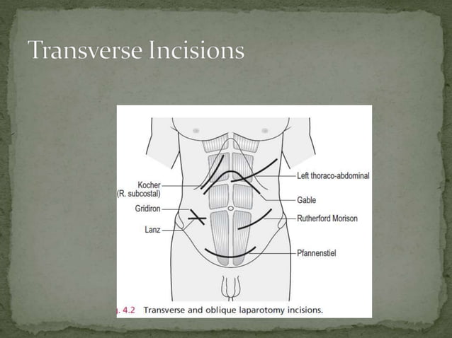 Abdomen layers & surgical incisions | PPTX | Death, Injury, or Military ...