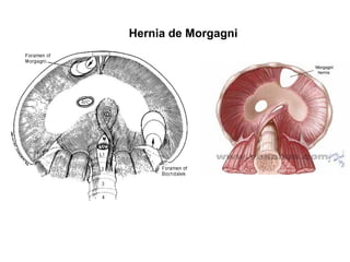 Hernia de Morgagni
 