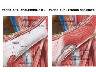 PARED ANT: APONEUROSIS O > PARED SUP : TENDÓN CONJUNTO
 