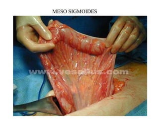 MESO SIGMOIDES
 