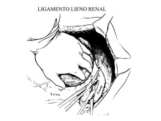 LIGAMENTO LIENO RENAL
 