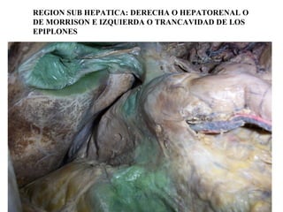 REGION SUB HEPATICA: DERECHA O HEPATORENAL O
DE MORRISON E IZQUIERDA O TRANCAVIDAD DE LOS
EPIPLONES
 
