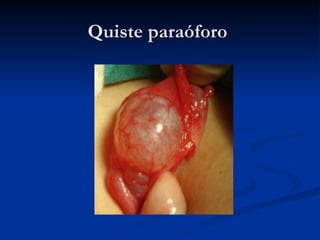 Quiste paraóforo  