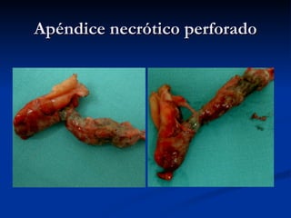 Apéndice necrótico perforado 