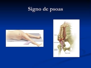 Signo de psoas 