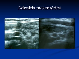Adenitis mesentérica 