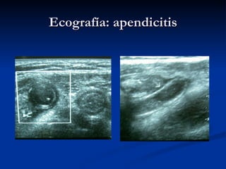 Ecografía: apendicitis 