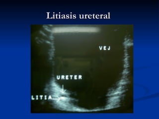 Litiasis ureteral  